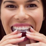 Clear Aligners