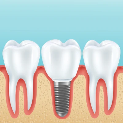 Dental Implants