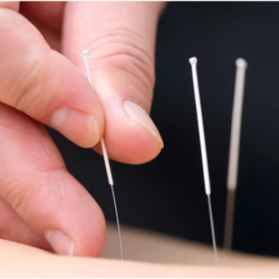Acupuncture Treatment